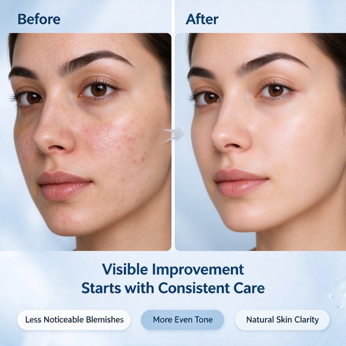 14% Azelaic Acid Facial Cream